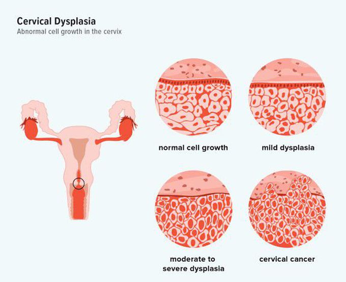 Cervical dysplasia