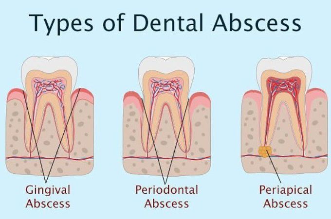Types of dental abscess
