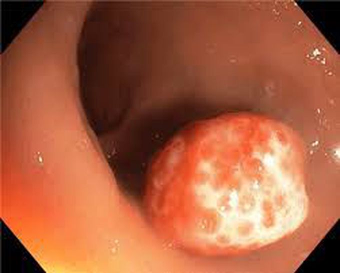 Rectal ulcers