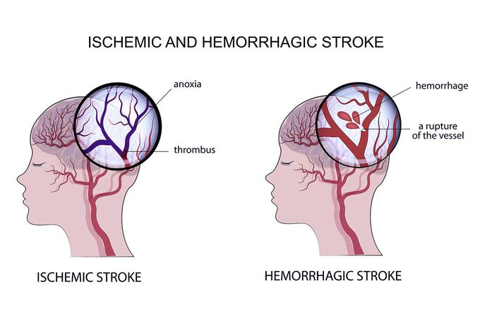 Types of stroke