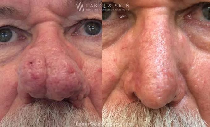 Rhinophyma treatment