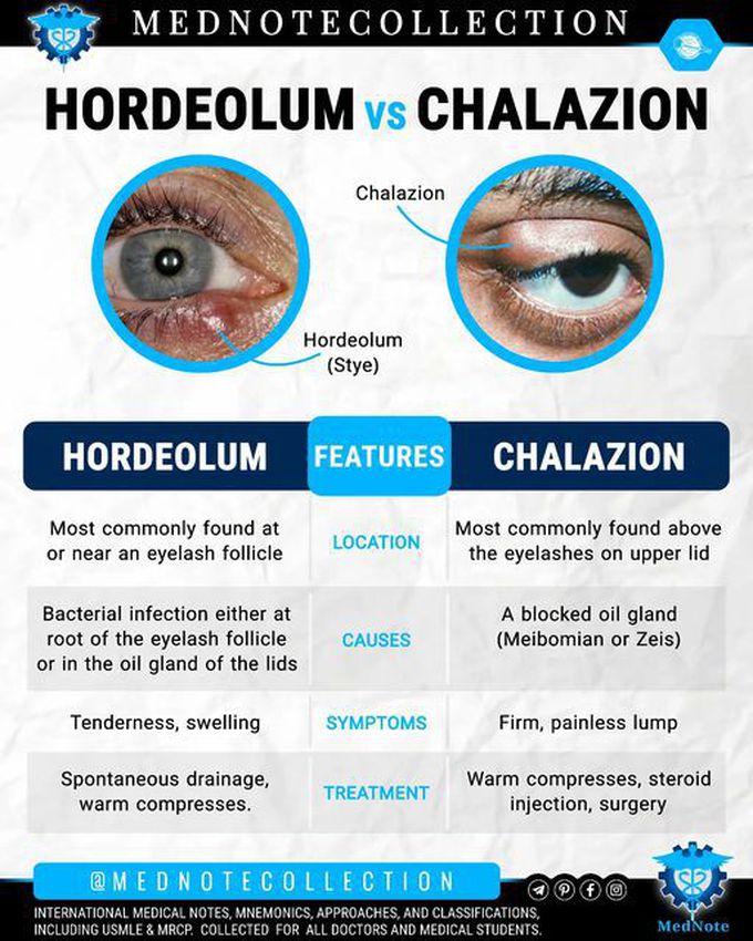 🧠 HORDEOLUM vs CHALAZION