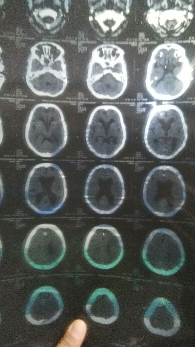 A 75 year old woman is a sudden onset giddiness and unble To speak. Admit that ICU department And complain... weakness RT. LL known case of HTN on Treatment.. No H/o DM. No H/O Trauma... And Examination Patient is altered sensorium GCS E4V2M5 Pupils BERL...... RT. LL reduced Movement  ?aphasia 
A CT Head is performed what is the most likely diagnosis