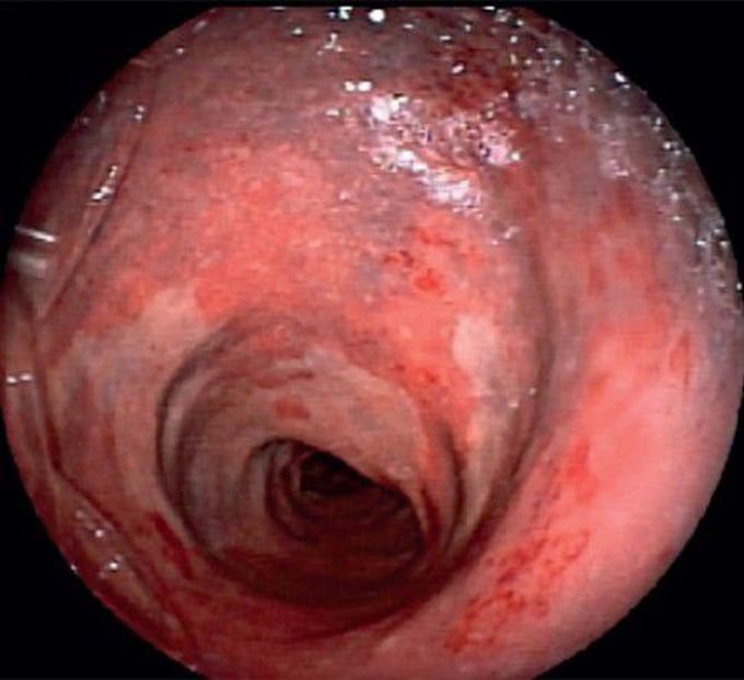 Rectal bleeding and red–purple masses on lower extremities