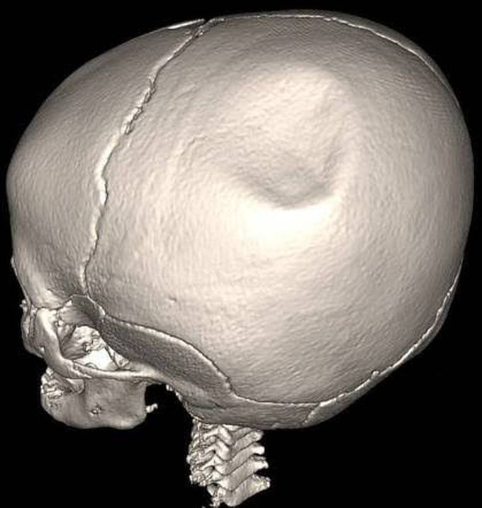 Pond fracture