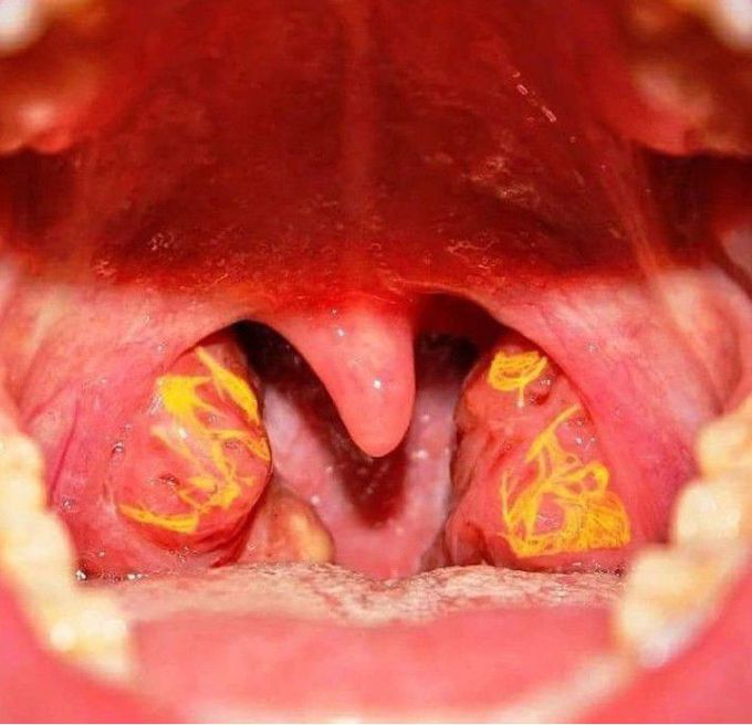 Tangier disease