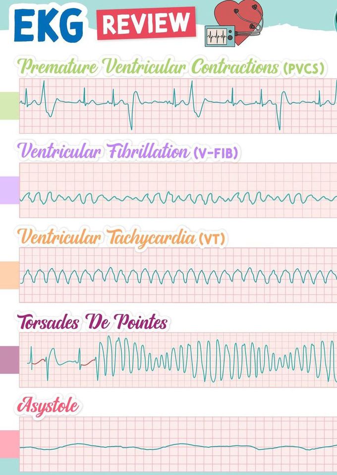 EKG  review II