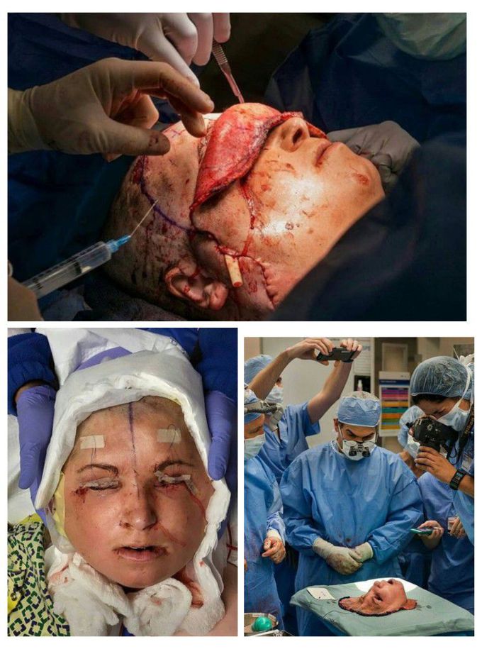 TOTAL FACE TRANSPLANT