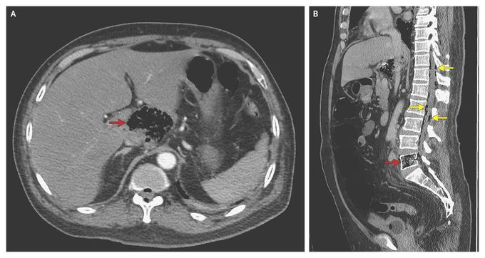 Metastatic Gas