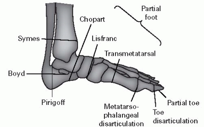 Foot Amputations