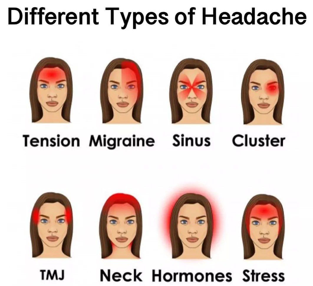 Different Types of Headache - MEDizzy