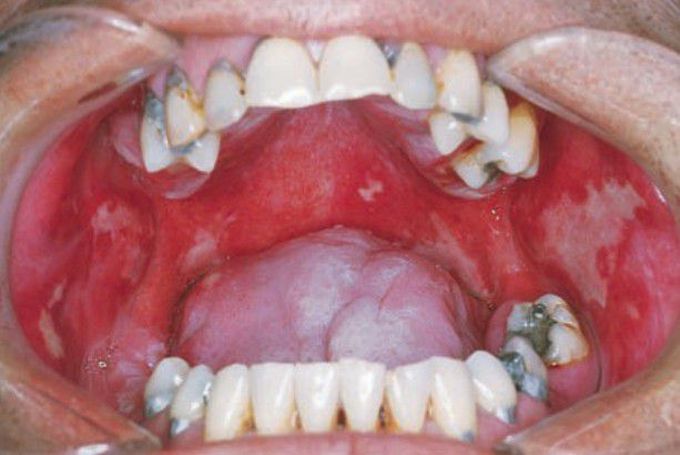 Radiation mucositis