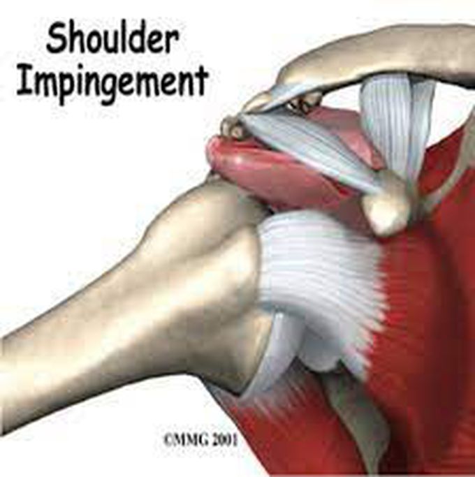 Treatment for Shoulder Impingement