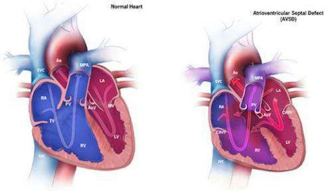 Heart Diseases in Individuals with Down Syndrome