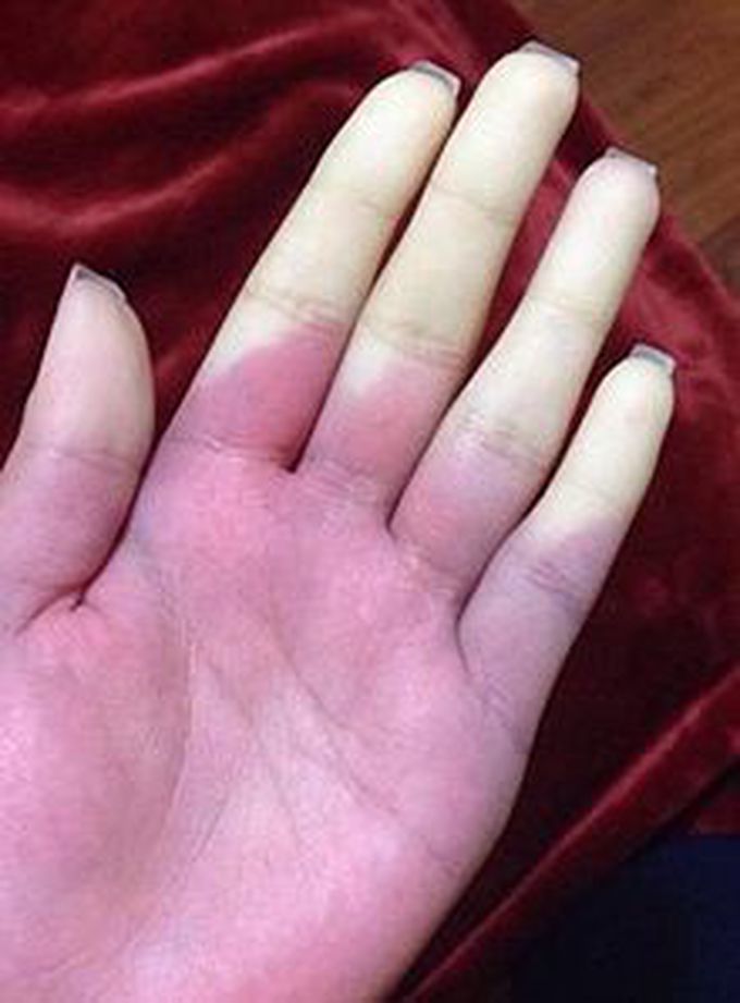 Conditions Associated With Raynaud's Syndrome