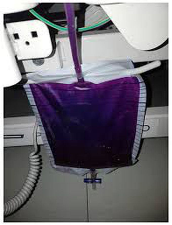 Purple urine bag syndrome (PUBS) is a rare phenomenon which can be highly concerning and distressing for patients and their relatives. It is a complication of urinary tract infections (UTIs) in which patients produce purple urine in their catheter tubing and bags.

Increased urine alkalinity: 