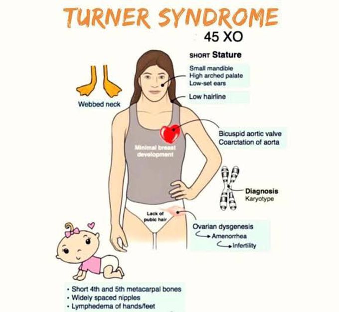 Turners syndrome causes