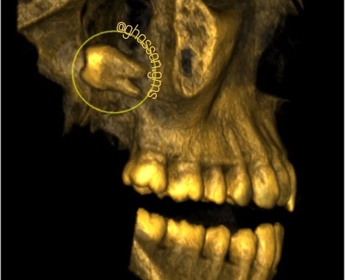 Maxillary Tooth Displacement