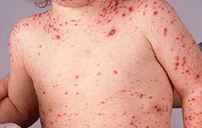 Chicken pox