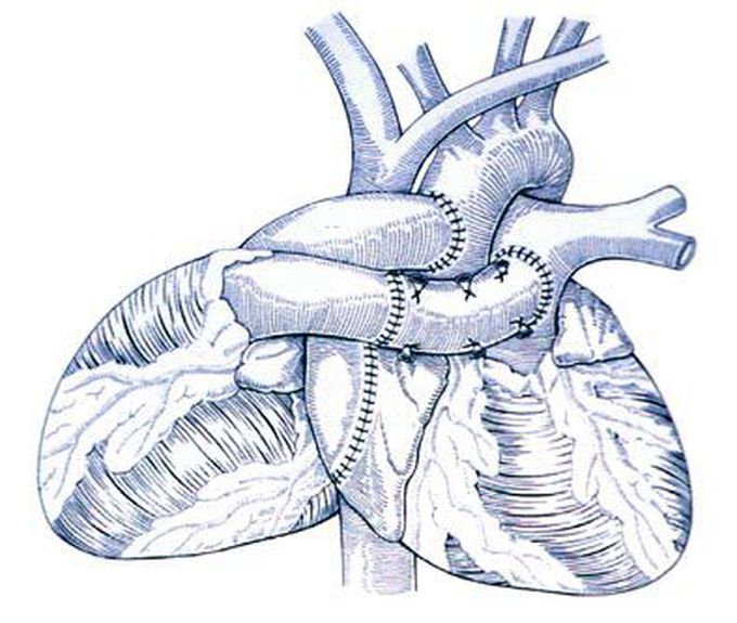 Heterotope Heart-transplantation