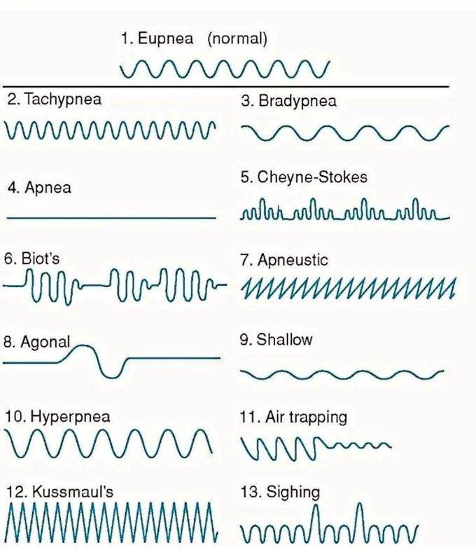 Abnormal Respiratory Rhythms