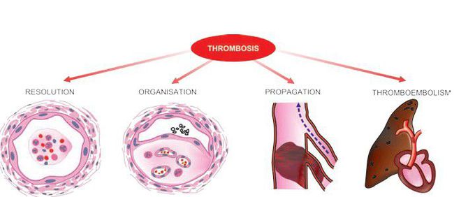 Thrombus