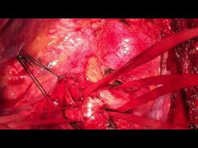 Case Presentation of Surgery for Double Aortic Arch Associated With Subclavian Artery Aneurysm