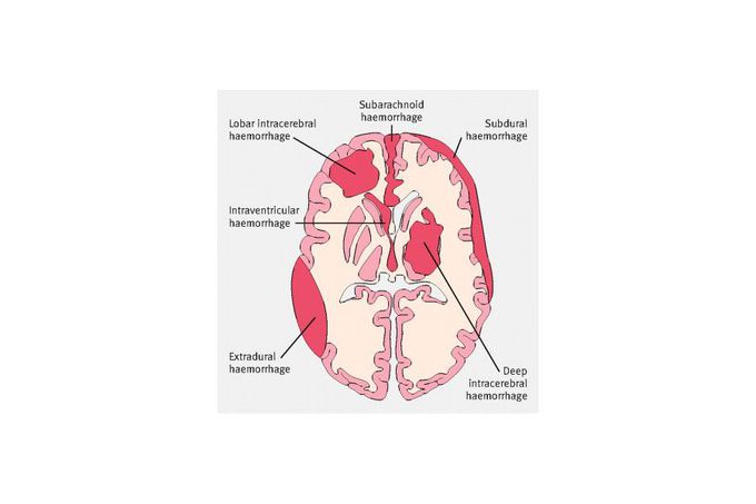 Management of intracranial hemorrhage