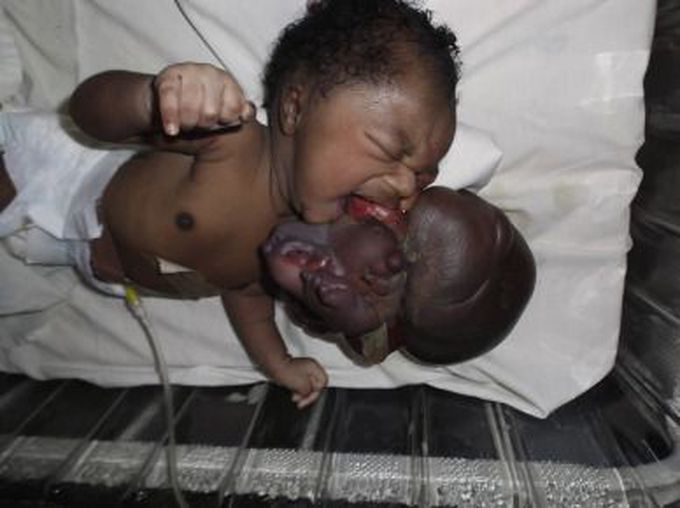 Fetus in Fetu
