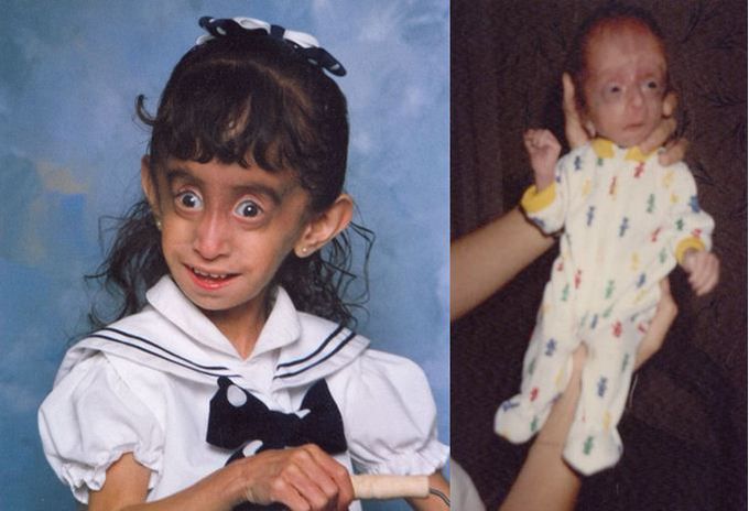 Marfanoid-Progeroid-Lipodystrophy Syndrome
