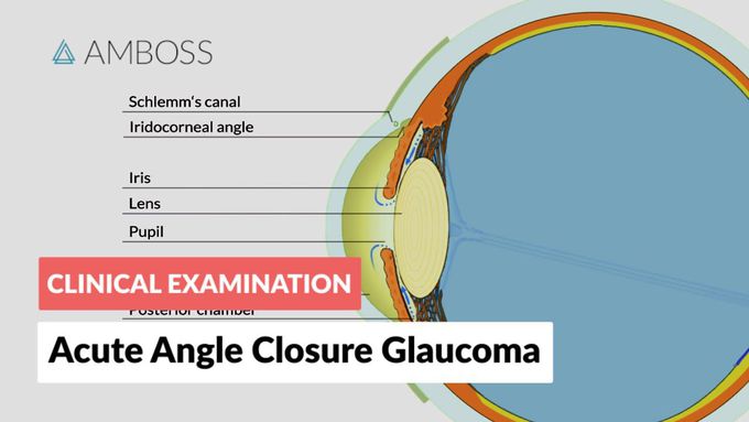 Acute Angle Closure Glaucoma