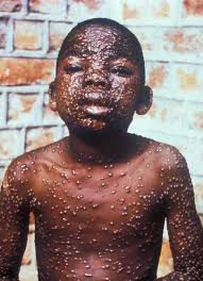 small pox