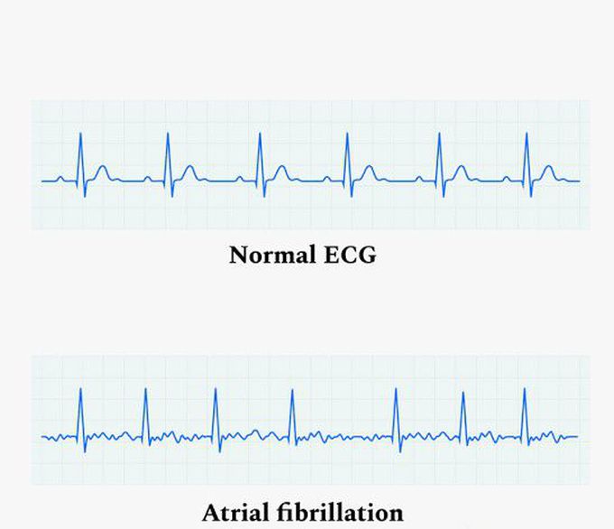 Symptoms of atrial fibrillation