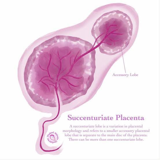 Succenturiate Placenta - MEDizzy