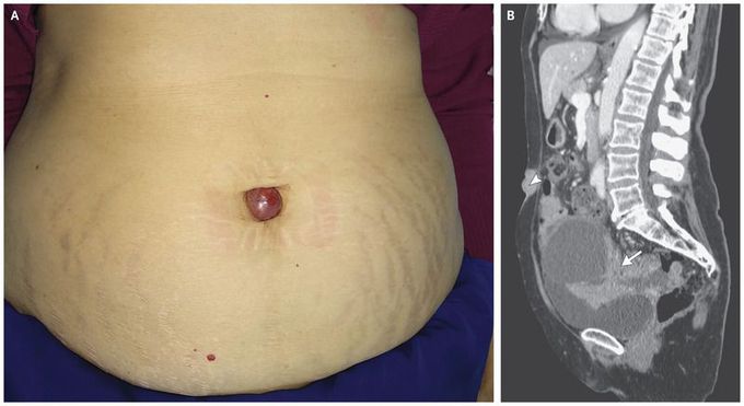 an-umbilical-nodule-medizzy