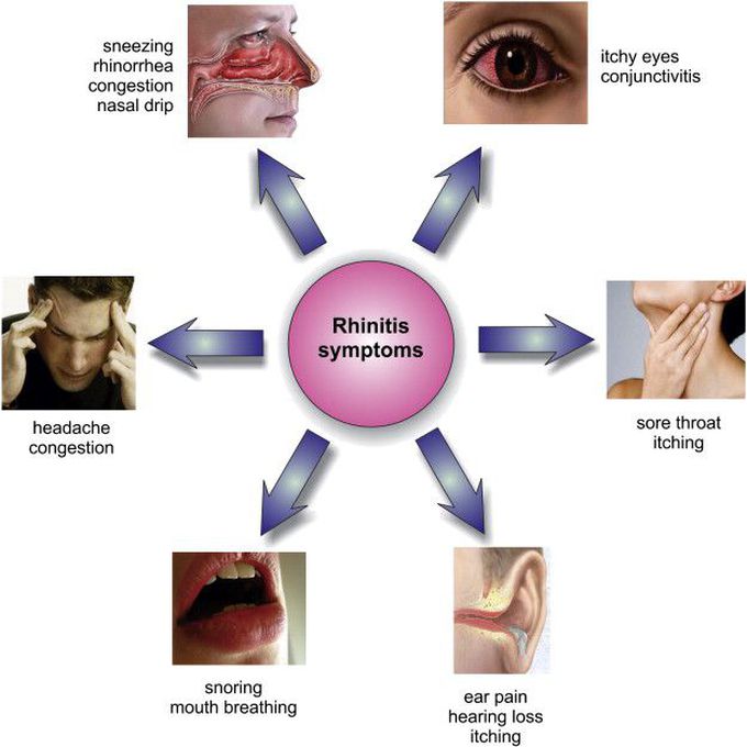 allergic-rhinitis-medizzy