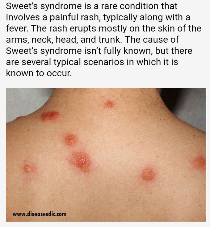 Sweet Syndrome Rash Pictures