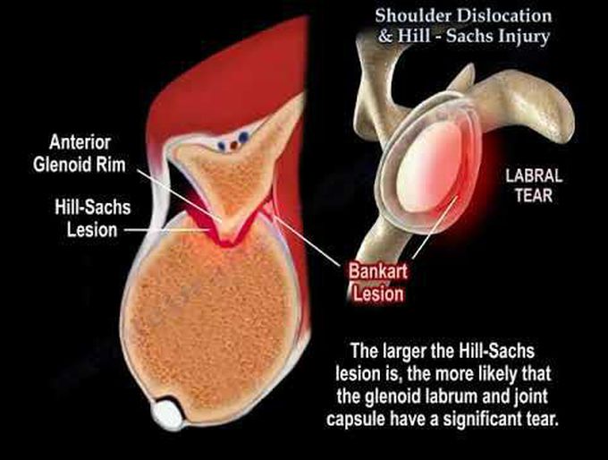 Shoulder Dislocation & Hill Sachs Injury - Everything You Need To Know - Dr. Nabil Ebraheim
