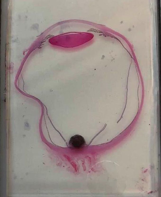 melanoma of the eye