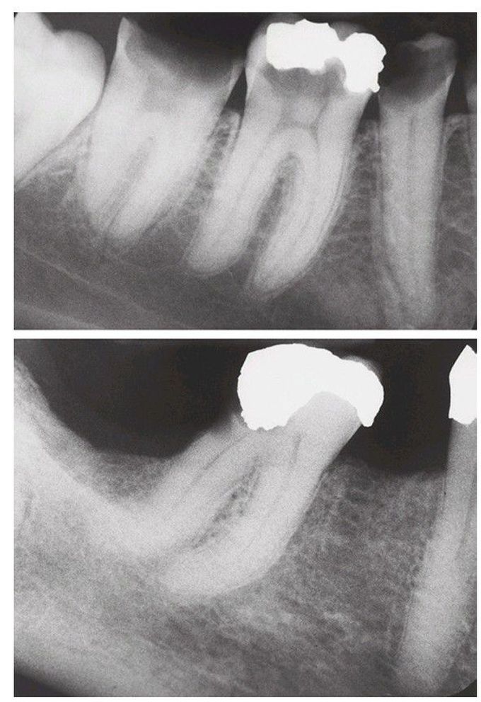 Difficult extraction case