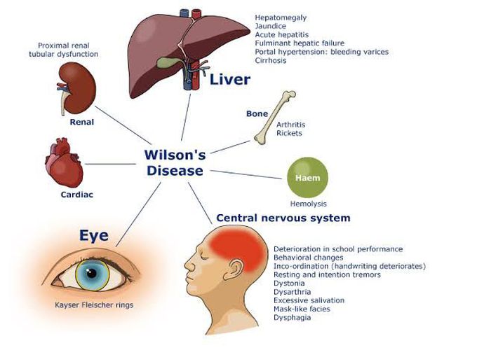 Wilson's disease