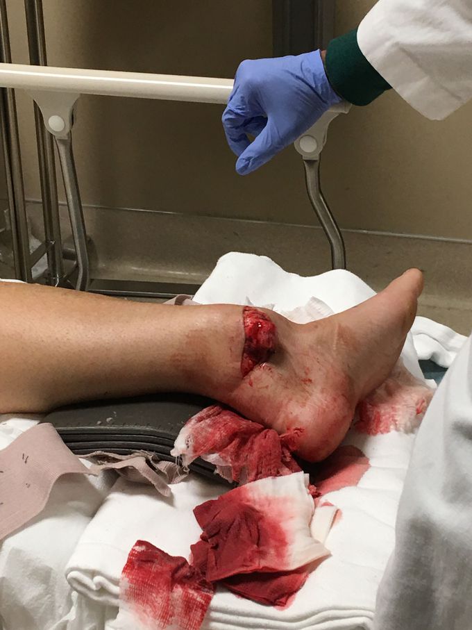 Ankle Fracture