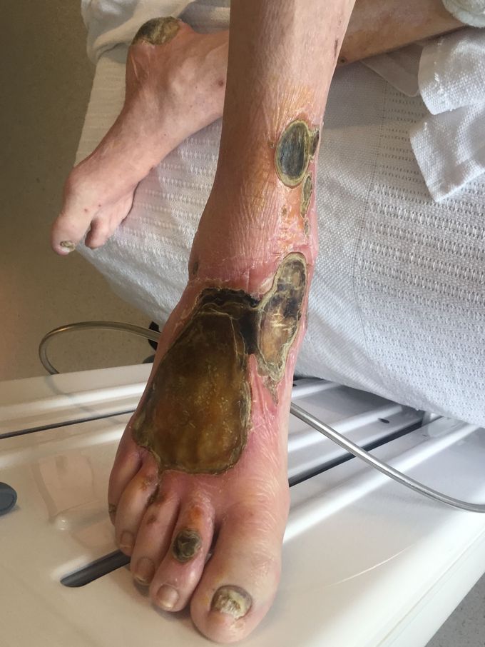 Bilateral diabetic foot ulcers