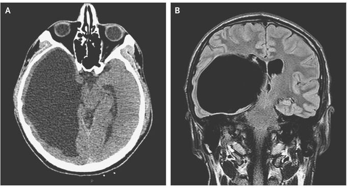 Arachnoid Cyst