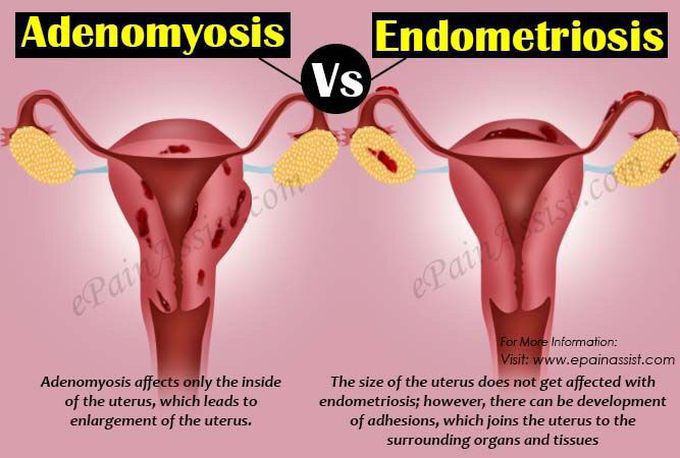 Endometriosis - MEDizzy