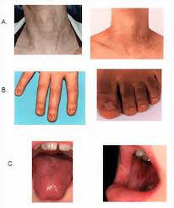 Symptoms of dyskerstosis congenita