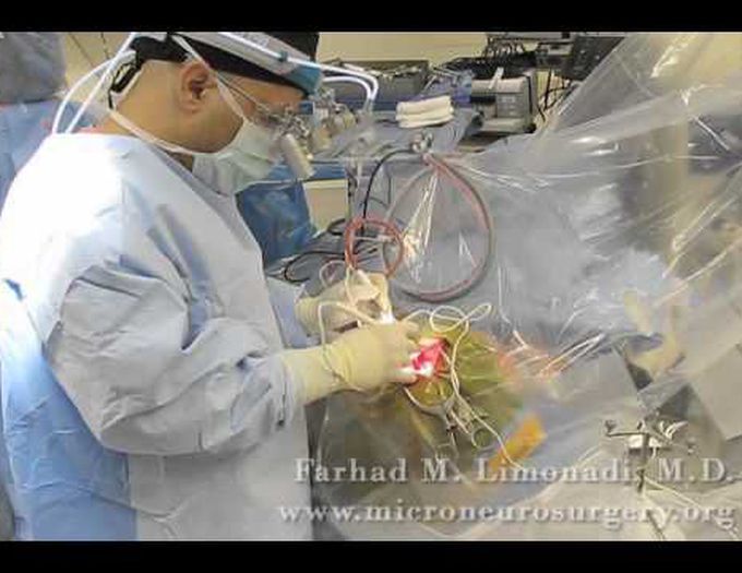 Awake Brain Surgery (Removal of brain tumor while patient is awake)