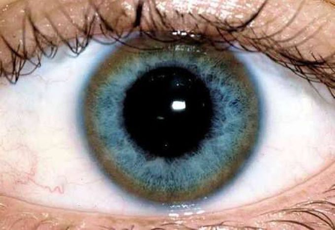 Kayser-Fleischer ring... Wilson disease 👀