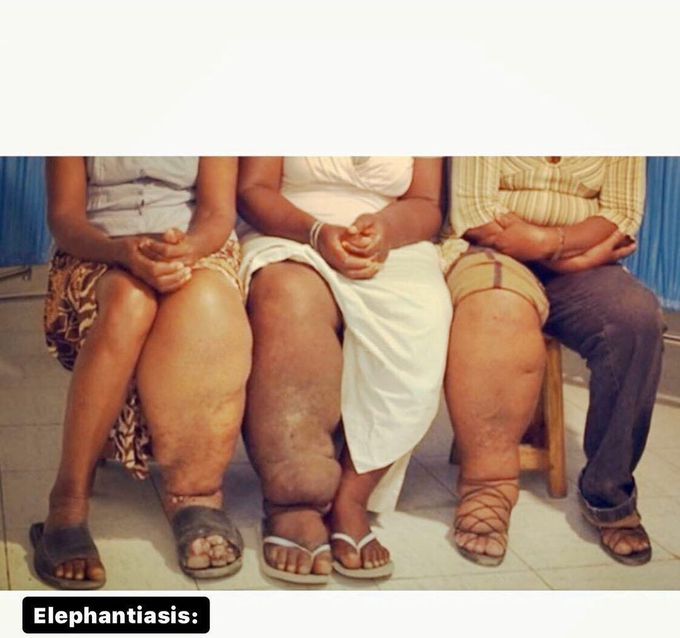 ELEPHANTIASIS