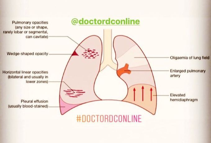 Chest x_ray pulmonary embolism